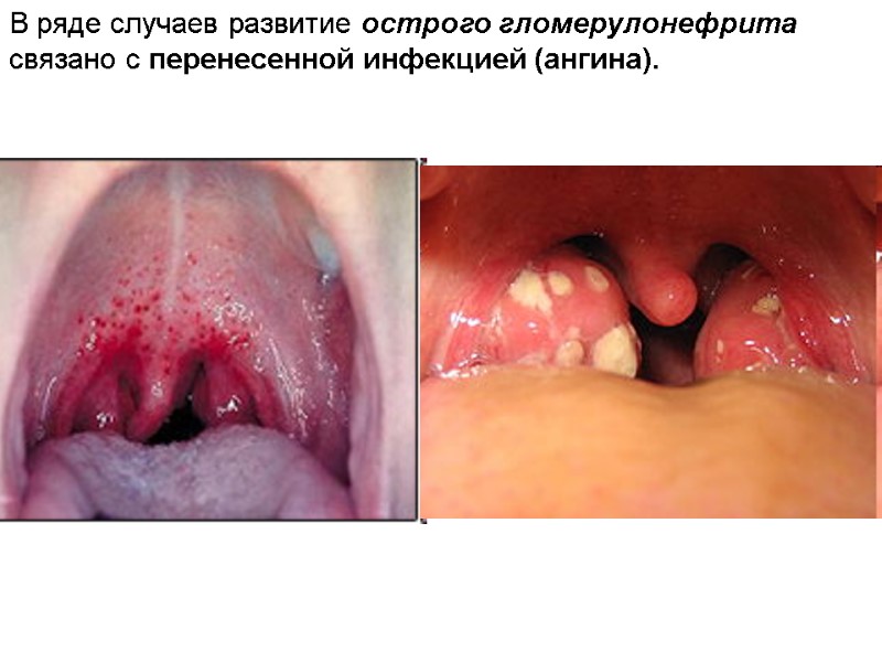 В ряде случаев развитие острого гломерулонефрита связано с перенесенной инфекцией (ангина).